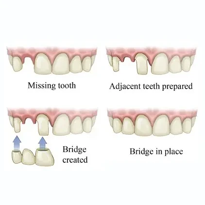 graphic of a dental bridge