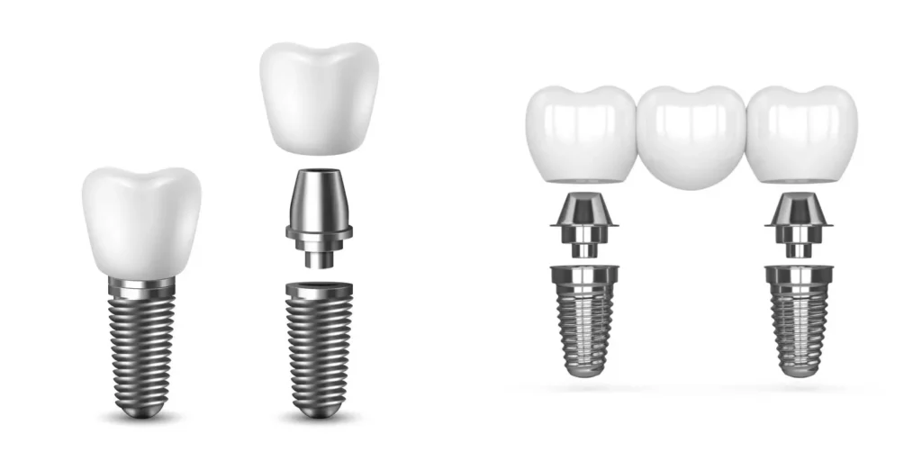 single tooth implant and multi-tooth implant bridge
