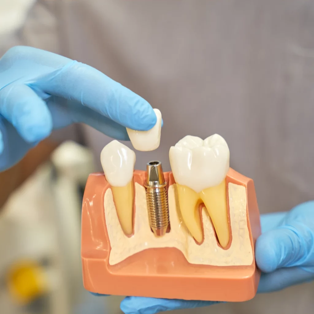 dental implant model with doctor placing porcelain crown