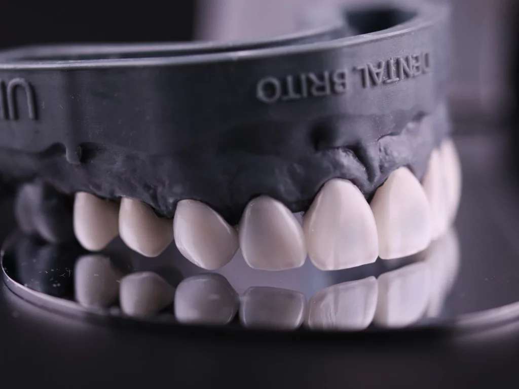 model of an upper set of porcelain veneers at Brito Family Dental