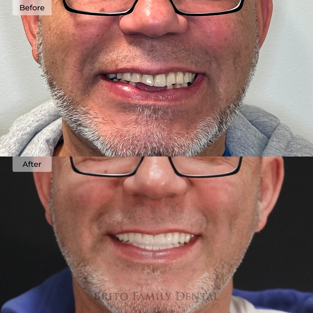 before and after dental implants at Brito Family Dental in Boston, MA