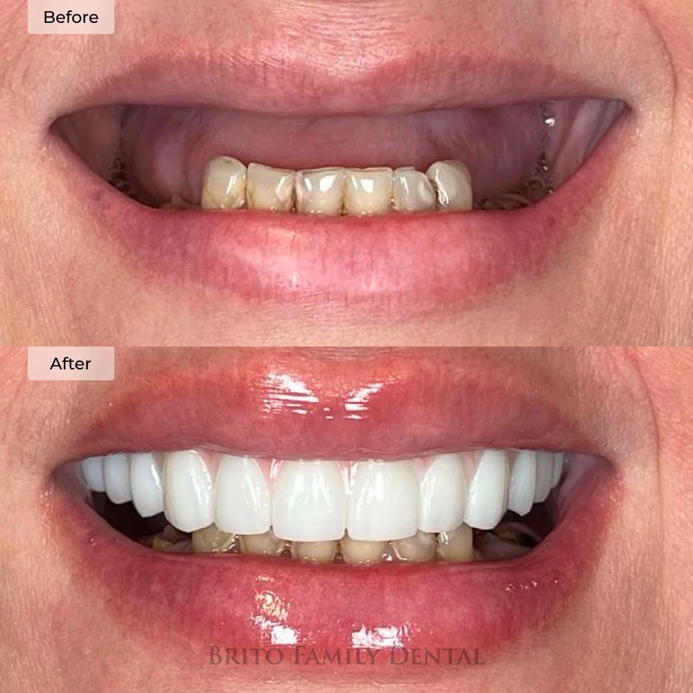 before and after dental implants in Boston, MA at Brito Family Dental