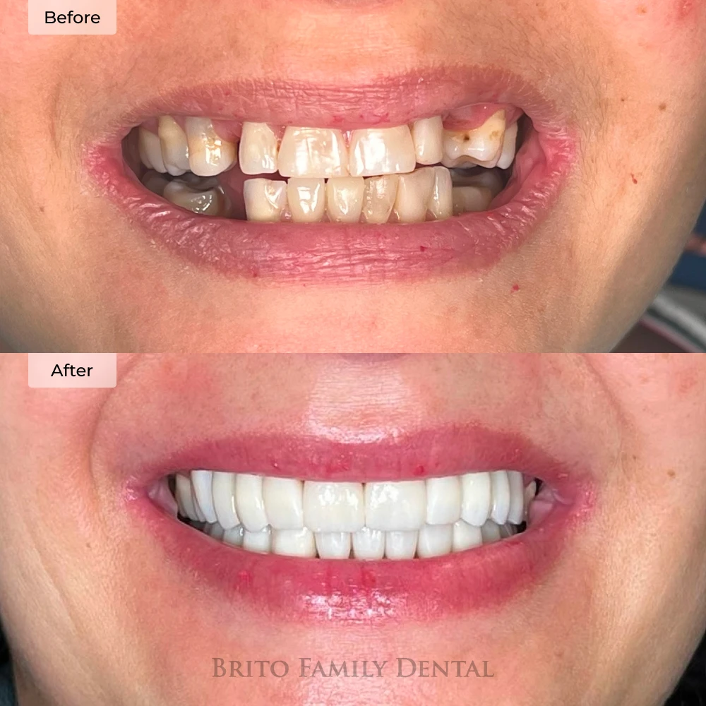 before and after dental implants at Brito Family Dental in Boston, MA