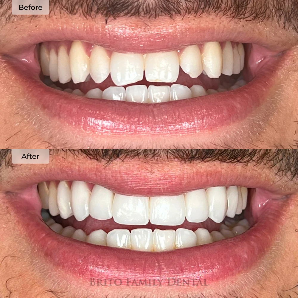 before and after porcelain veneers at Brito Family Dental in Boston, MA