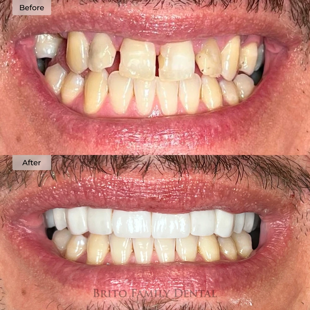 before and after porcelain veneers at Brito Family Dental in Boston, MA