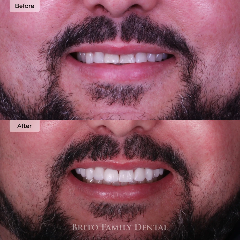 before and after porcelain veneers in Boston, MA at Brito Family Dental