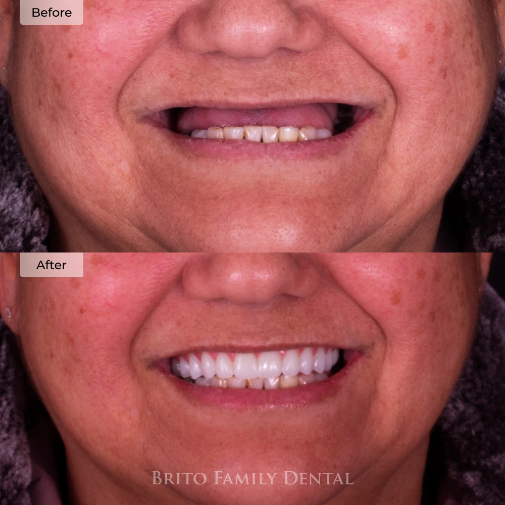 before and after dental implants in Boston, MA at Brito Family Dental